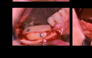 Reconstruction mandibulaire postérieure par greffe osseuse autogène